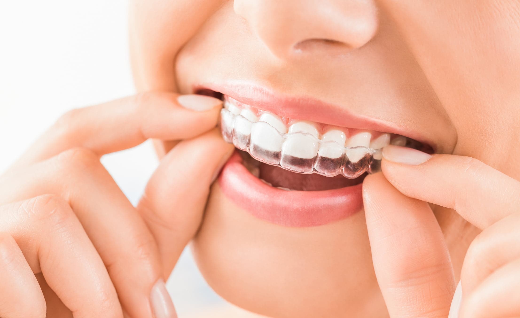 invisalign_OdgNeS7.jpg